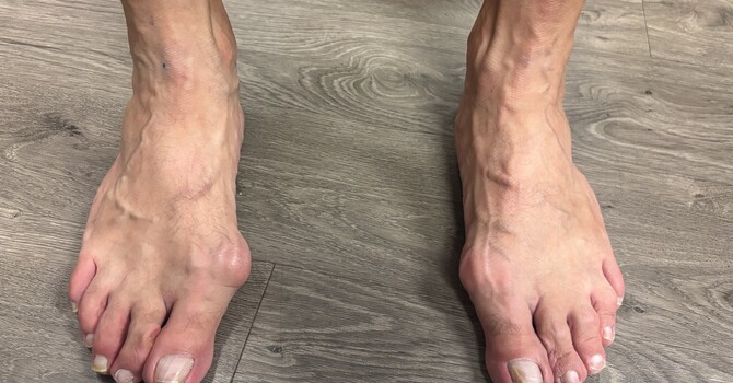 Why a Biomechanical Assessment Is Required Before Casting for Custom Foot Orthotics