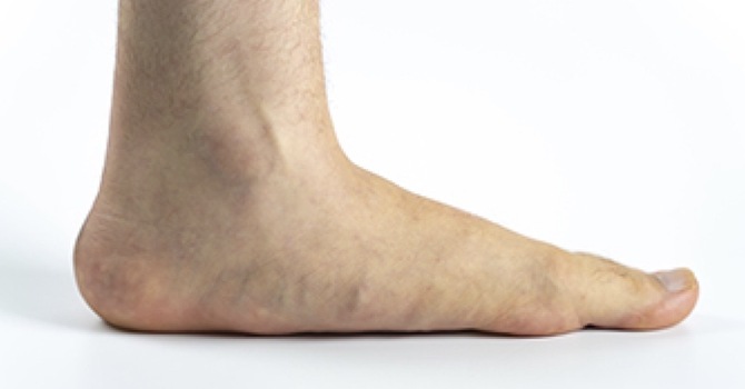 Flat Feet, Activity, and Injury Prevention